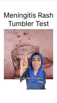 Don’t ignore these EARLY signs o Meningitis and how the meningitis rash can look on darker skin