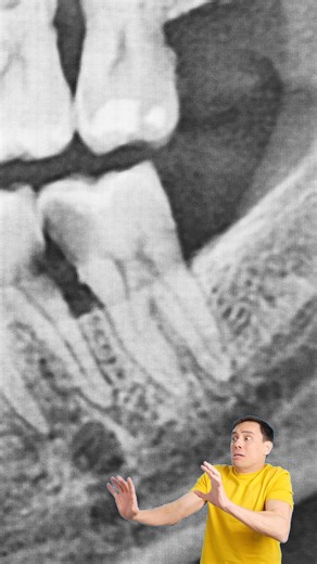 Copper Basin Oral Surgery | Dr. Ben Zuniga, DDS on Instagram: "An odontoma sounds scary, but it’s basically a small clump of tooth tissue that grew in the wrong way. Most of the time it doesn’t hurt, but it can block teeth from coming in or cause swelling. That’s why dentists recommend treating it early.Treatment is usually simple, and once it’s removed, the problem is solved. So: not dangerous, just something you don’t want to ignore. #copperbasinoms #oralsurgery #oralhealth #smile"