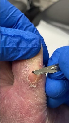 Satisfying Big Toe Callus Removal Cutting Thick Dry Skin #FootCare #CallusRemoval