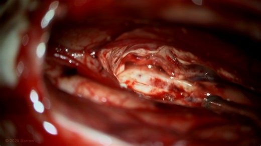 #433: Transcallosal-Transchoroidal Fissure Approach for Resection of an Interpeduncular Midbrain Cavernous Malformation - All Videos - Seven Series Collection