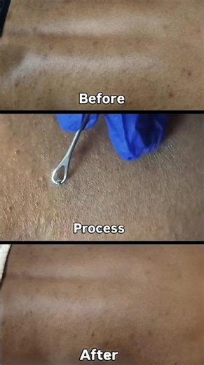 Professional Comedone Extraction | Blackhead & Whitehead Removal | Before & After Transformation ✨