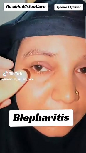 Understanding Blepharitis: Causes and Management