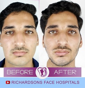 All That You Must Know About Hemangiomas – Richardson's Plastic Surgery Hospitals