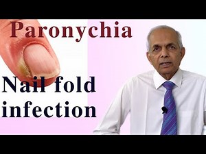 Nail fold infection ( Paronychia), causes, symptoms and treatment #nailinfection