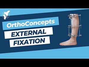 External Fixation • Video • MEDtube.net