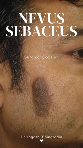 SHIVANI SKIN CARE on Instagram: "Nevus Sebaceous is a congenital hamartoma, often presenting as a yellowish, hairless plaque at birth—most commonly on the scalp or face. Though benign in childhood, it may thicken at puberty and has a small risk of neoplastic transformation in adulthood. Regular dermatologic evaluation is advised. 🔬 #NevusSebaceous #Dermatology #SkinLesion #PediatricDermatology #Hamartoma #ClinicalDermatology #SkinSurveillance #DermEd #MedicalEducation #NevusSebaceous #Dermatolo