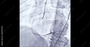 Coronary angiogram of coronary artery during cardiac catheterization in cardiac catheterization laboratory.