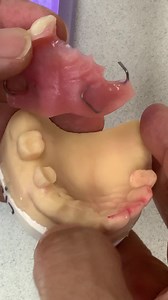 Upper Acrylic Flipper Partial with Metal Clasps. Case from Dr. Paul Connolly in New Hampshire. EnvisionTEC Bedford Center for Prosthodontics | LSK121 Oral Prosthetics