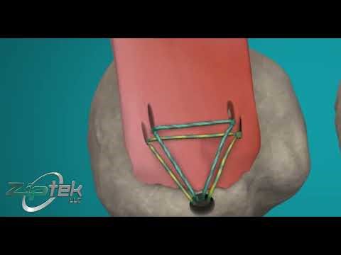 ZipE®: The Missing Tendon-Side Compression Solution for Anchor-Based Repair