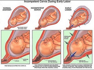Incompetent Cervix - Losing a pregnancy before 24 weeks