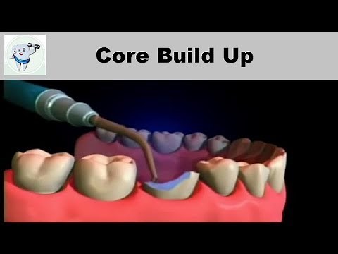 Core Build up After Root Canal