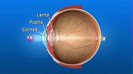 ¿Qué es la hipermetropía?
