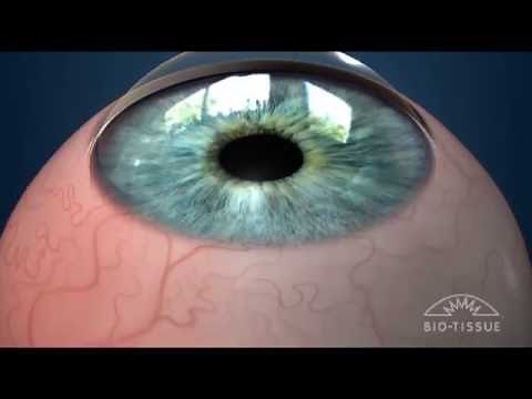 Treatment of Conjunctivochalasis (CCH) with Bio-Tissue