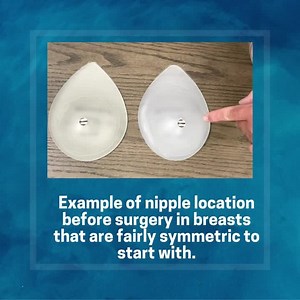 Ideal Implant Positioning