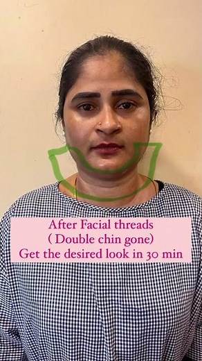 Facial Thread Lift in Hyderabad | Tighten & Rejuvenate Your Skin at VJ Clinic