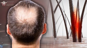 Hair loss 101: Causes, prevention, and regrowth options