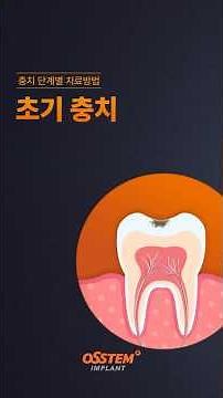 충치 단계별 치료방법 - 초기 충치 #shorts