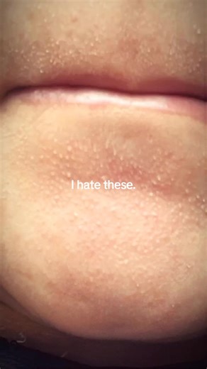 Whiteheads & Acne Patches: A Closer Look