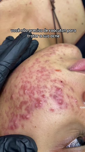 Quer acompanhar a evolução dessa pele? Comenta para parte 2 #VozDosCriadores #acne #limpezadepele #tratamentofacial #espinhas #cravos #peleacneia #peleoleosa #esteticafacial