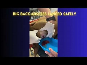 BIG BACK ABSCESS LANCED SAFELY