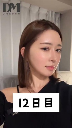 A facelift in my 20s? A 2-month record of fixing sagging after facial contouring surgery #Facelif...