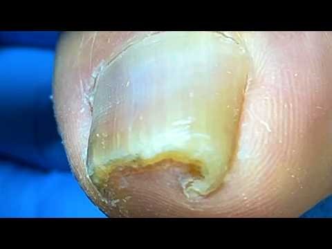 The Amazing Curl Of The Ingrown Nails! Trim It Carefully【Xue Yidao】