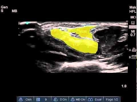Diagnostic Carpal Tunnel Ultrasound Exam - How To