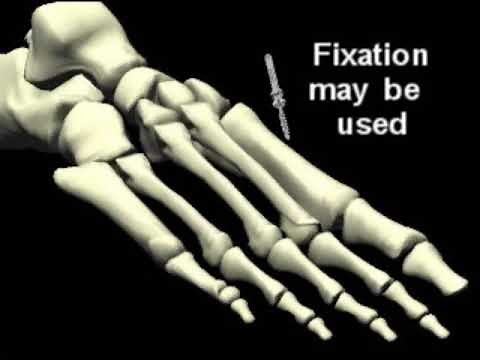 Weil Lesser Metatarsal Osteotomy (Severe hammertoe correction procedure)