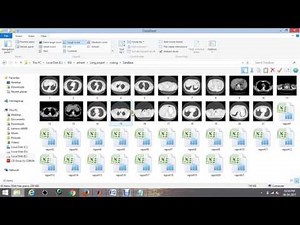 Content-Based Image Retrieval by Metric Learning From Radiology Reports (Lung)