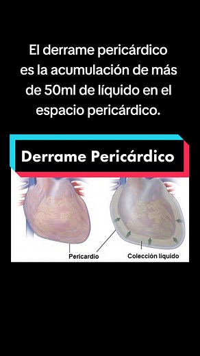El derrame pericárdico es la acumulación de más de 50ml de líquido en el espacio pericárdico. La etiología puede ser de causa idiopática o deberse a enfermedades primarias del pericardio, como las pericarditis de cualquier etiología, o por enfermedades sistémicas como el infarto agudo de miocardio y la rotura cardiaca contenida; o por cirugía cardiaca, hemorragia intrapericárdica, enfermedades metabólicas, transudación serosa (anasarca) y quilopericardio, entre otras. #derramepericardico #pericá