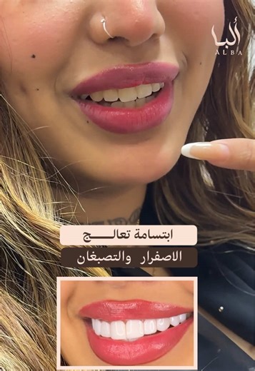 ابتسامة الدايركت فينيرز: الحل السريع لأسنان هوليوود