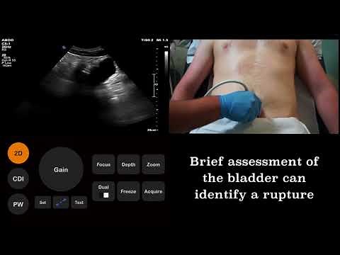 Ultrasound Tutorial: FAST (Focused Assessment with Sonography for Trauma) scan | Radiology Nation