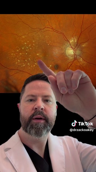 Let’s go through a nice little illustrative case of macular degeneration, Part 1! At one point in this video “diabetic retinopathy” slipped into the discussion. Yeesh I talk about it so much, it can happen. I really meant to say that there is macular degeneration as well in the left eye. My bad. #eyes #retina #ophthalmology #maculardegeneration