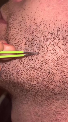 My Multigemini hair tweezing🚀✨ #plucking #beard #contentmonetization #reels #family #multigemini #pick | Eithan Dickerson