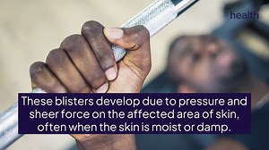 What Is a Friction Blister? Here's What to Know—and How to Treat It