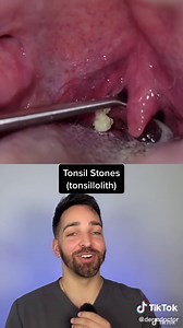 Throat Cheese? @TonsilStoneDude #dermdoctor #tonsilstones | tonsil stones
