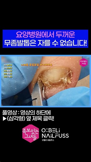 요양병원에서 방치된 무좀발톱! 😎#내성발톱 #toenails #ingrown_toenail #발톱무좀 #무좀 #무좀발톱 #족보있는그녀들