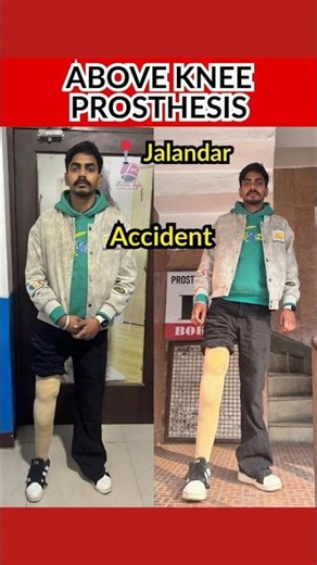Above Knee Artificial Leg #prostheticlimb #artificialleg #artificiallimb #abovekneeprosthetic #short