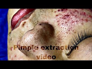 How Satisfying Pus Filled Pimples Formed ? || Detail video