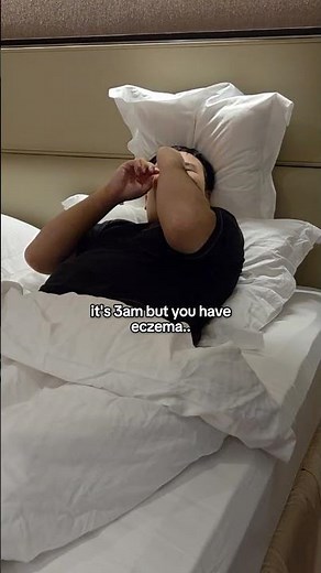 living with eczema is so hard #eczema #eczemaawareness #relatable #chronicillness
