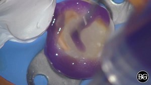Bonding of E.max crown. Some steps of tooth structures adhesive preparation. . 📍Sequence: ▪️1. Sandblasting. ▪️2. Etching (enamel 30 sec, dentin 10 sec). ▪️3. Bonding agent application. I prefer not to light cure it. ▪️4. Putting cement on margins and crown filled with cement. ▪️5. Cleaning and light curing. . More about bonding, veneers and esthetic planing we teach during Module 3: All about veneers. . ❗️New dates available. 🗓6-8 December 2019. Book your seat via web ➡️ https://u.to/MR0pFQ ➖