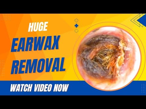 001-Huge Earwax Removal Under Microscope | Satisfying & Relaxing - Earwax World