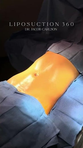 Skinny Lipo 360 🔥 Snatched, Defined Results | Dr. Carlson at Aeris