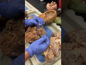 7-8→ DURAL VENOUS SINUSES, CRANIAL MENINGES AND SPACES, AND CRANIAL DURAL SEPTA