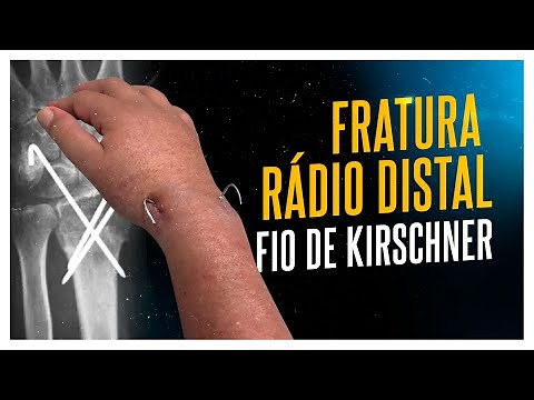 FRATURA DO RÁDIO DISTAL| COMO É TRATAMENTO COM FIO DE KIRSCHNER E QUANDO TIRAR?