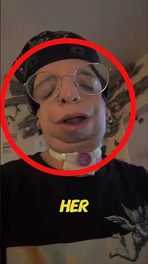 💙 Shocking Face Transformation? The Truth About Treacher Collins Syndrome! 💙