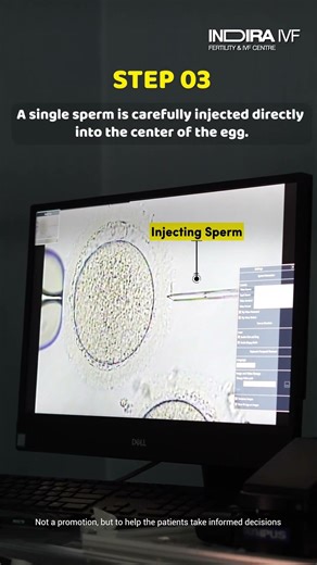 Here's How ICSI is Done Step-by-Step | Indira IVF | Procedure Video