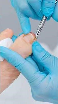 Ingrown Toenail Explained (and How to Fix It)