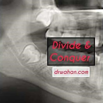 Mesioangular Wisdom Tooth Extraction Video