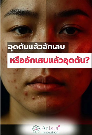 อุดตันแล้วอักเสบกับอักเสบแล้วอุดตัน . สองอย่างเนี่ยอาจจะดูเหมือนกัน แต่ว่ากลไกการเกิดมันแตกต่างกันทางแก้ก็แตกต่างกัน . อุดตันแล้วอักเสบเกิดจากการที่ร่างกาย มีการผัดเซลล์ผิวช้ารวมทั้งผลิตน้ำมัน ส่วนเกินบนผิวมากกว่าปกติ ก็เลยเกิดการอุดตัน . แต่อักเสบแล้วอุดตัน ในงานวิจัยใหม่ใหม่เราถึง สารอักเสบที่ก่อตัวตั้งแต่ยังไม่เกิดสิว ซึ่งสารอักเสบนี้เองที่เป็นตัวการทำให้กระตุ้นการสร้างเซลล์ที่ปากรูขุมขนมากกว่าปกติ และตัวการที่ทำให้เปลี่ยนแปลงโครงสร้างน้ำมันจนกระทั่งเกิดการอุดตันได้ง่าย . อุดตันและอักเสบเราอา